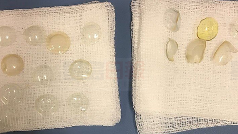 女子退休后 从眼中取出27个隐形眼镜