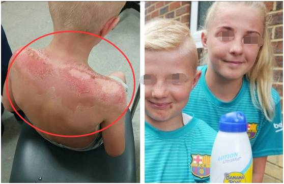 这款防晒霜请立即停用！婴儿脸被灼烂 2月187人伤