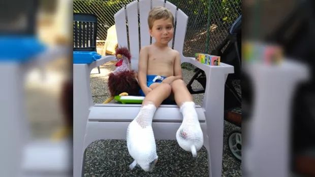 列治文妈妈带孩子去海滩玩 3岁儿子竟被严重烧伤