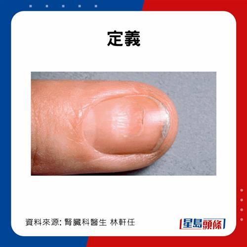 20221203_health_nail1_2