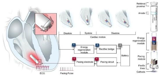 中国科学家研制出“胶囊版”自供电微型心脏起搏器